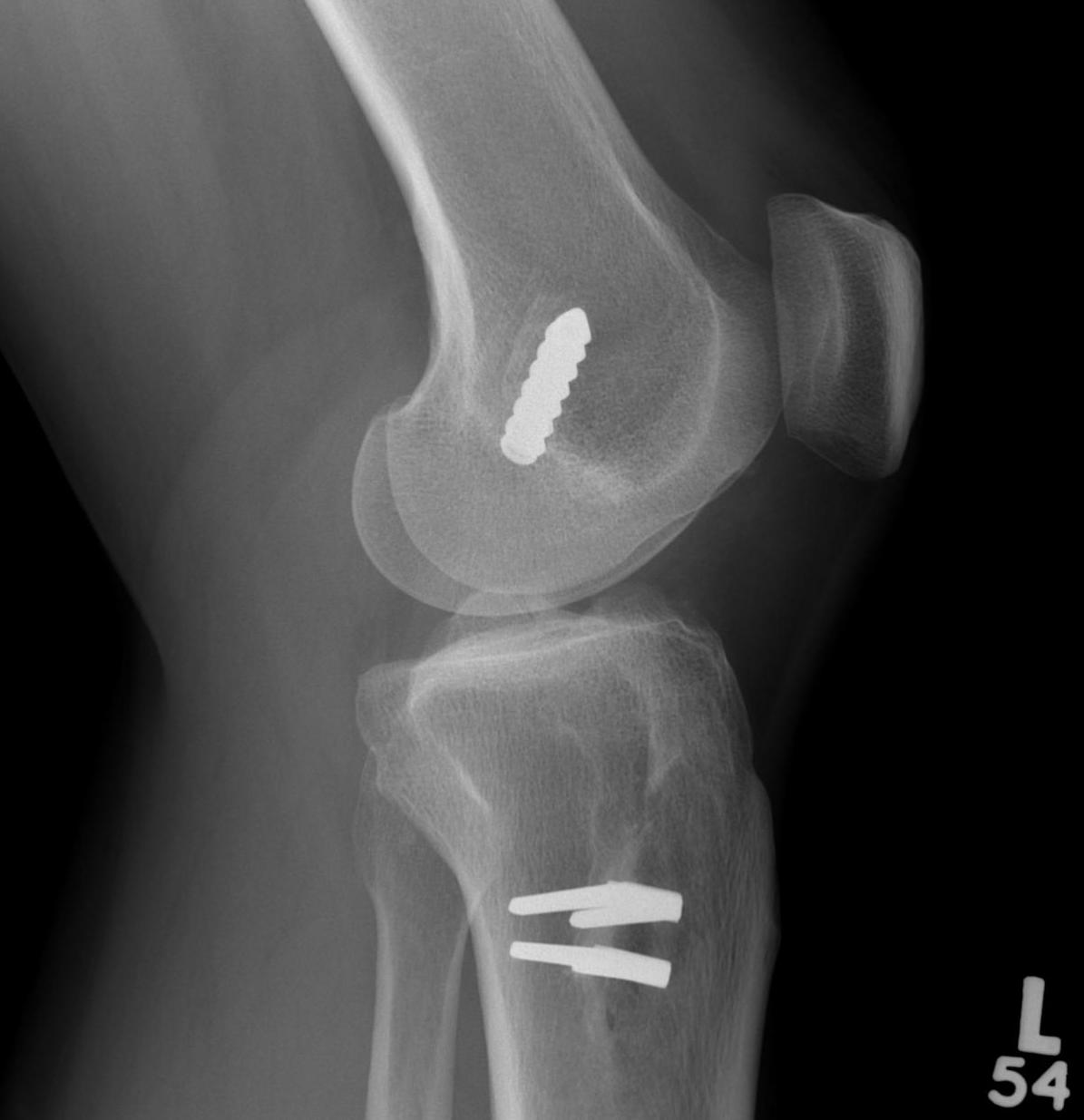 Revision ACL Graft Placed posterior to old femoral tunnel